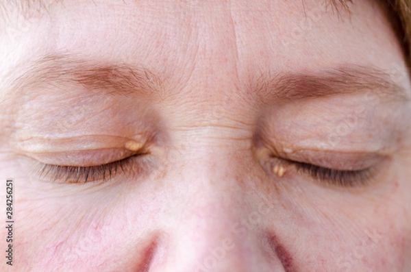 Obraz Womens eyelids with small growths due to disorders of lipid metabolism. Medical and cosmetology problem.