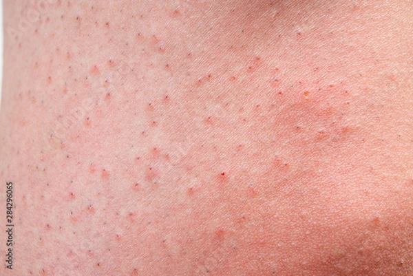 Obraz カミソリ負けして赤くなった男性の脚