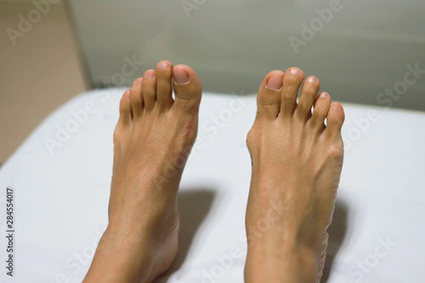 Fototapeta  Hallux Valgus in an Asian girl before and after Proximal phalanx osteotomies. Left feet is after surgery and Right feet is befor surgery.