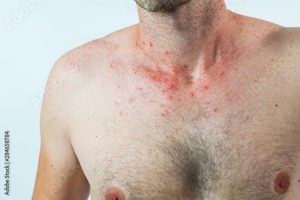 Obraz man with spider veins on the neck and chest