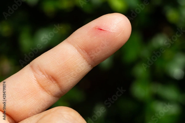 Fototapeta Woman has been cut index finger and scar skin on hand, Close up & Macro shot, Asian Body skin part, Healthcare concept, Bokeh green garden background