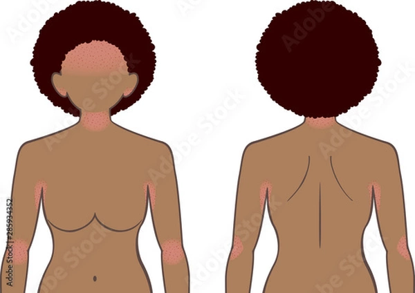 Obraz あせも・湿疹　上半身　女性