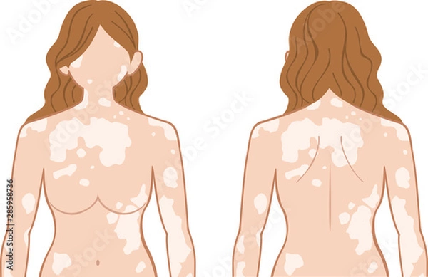 Obraz 白斑　上半身　女性