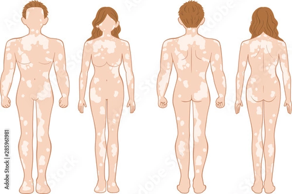 Obraz 白斑　全身　男女セット