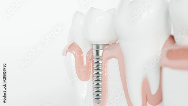 Fototapeta Healthy teeth and an implant - 3d rendering