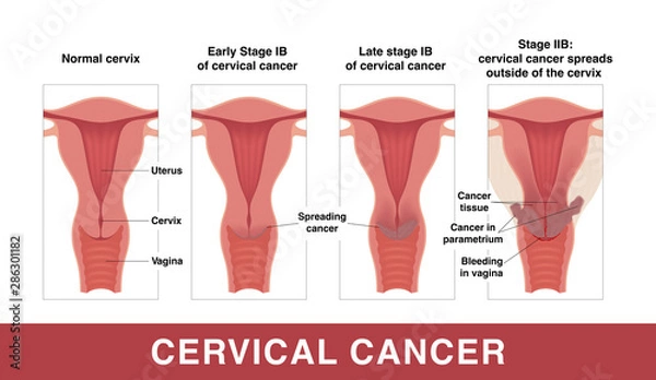 Obraz Cervical cancer. Three stages of cancer. Vector medical illustration with inscriptions. Female reproductive organs. Frontal view in a cut.