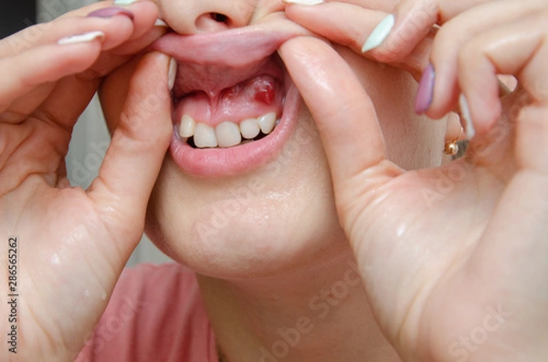 Obraz Close-up of gum with cyst or purulent flux. Disease of the gums and teeth.