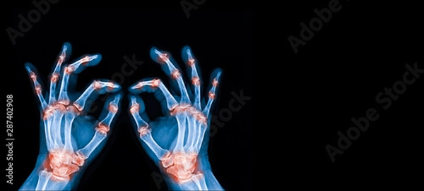 Fototapeta X-ray image both human's hand and wrist x-ray showing severe arthritis of the wrist or carpus and Boutonniere deformity of the thumb. The patient has advanced rheumatoid arthritis. Dark background.