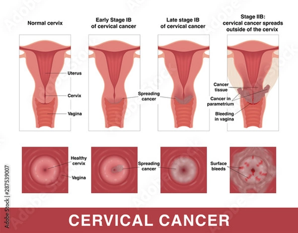 Obraz Cervical cancer. Three stages of cancer. Vector medical illustration with inscriptions. Female reproductive organs. Frontal view in a cut and top view.