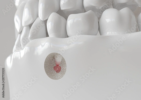 Obraz Root tip inflammation with apicectomy - 3D rendering