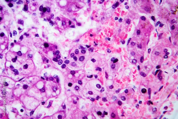 Fototapeta Small nodular cirrhosis, light micrograph, photo under microscope