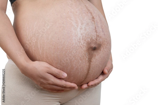 Obraz Belly of a pregnant woman with stretch marks on white background.