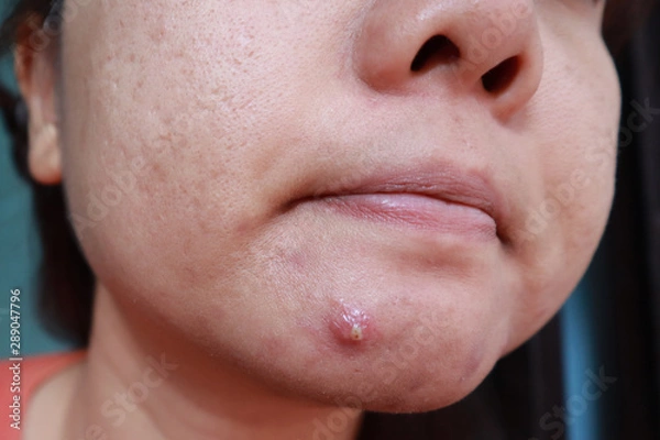 Fototapeta Woman squeezing pimple with dirty bare hands, Removing pustules whitehead acne from face, Problems with acne and scar on the female skin.