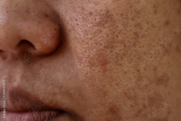 Fototapeta Skin problem, Closeup skin face asian women with spot melasma,  Dark spots, freckles, pigmentation  Skincare problem concept.