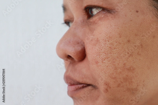 Fototapeta Skin problem, Closeup skin face asian women with spot melasma,  Dark spots, freckles, pigmentation  Skincare problem concept.