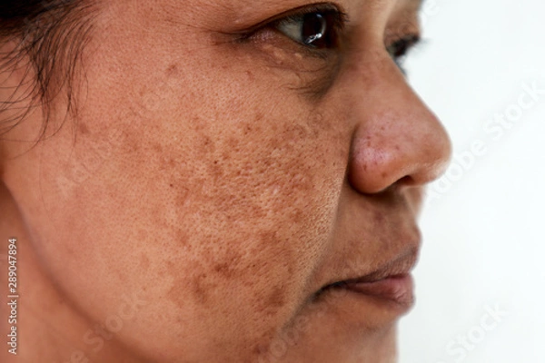 Fototapeta Problem skóry, zbliżenie skóry twarzy azjatyckie kobiety z melasma, ciemne plamy, piegi, pigmentacja Koncepcja problemu pielęgnacji skóry.