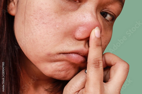 Obraz Woman pointing finger at blackhead acne from face, Problems with acne hormonal pimples and scar on the female skin, Skin problem