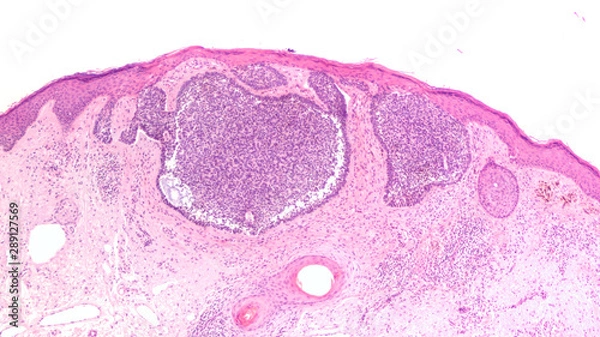 Fototapeta Skin biopsy pathology of basal cell carcinoma, the most most common type of sun induced skin cancer, invading the dermis.  Regular use of sunscreen can be preventative.