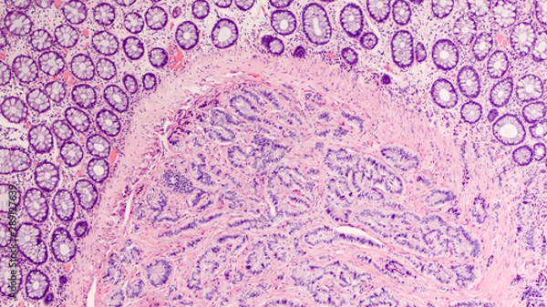 Fototapeta Photomicrograph of a carcinoid tumor, a type of neuroendocrine tumor (NET), which presented as a colon polyp during routine colonoscopy.  Spread to liver can cause symptoms of carcinoid syndrome.