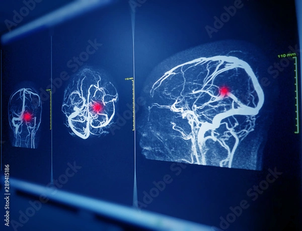 Fototapeta MRA AND MRV OF BRAIN  Finding:Bilateral territorial muscles to the cortex and subcortical of the parietal and low hemispheres cerebellar.