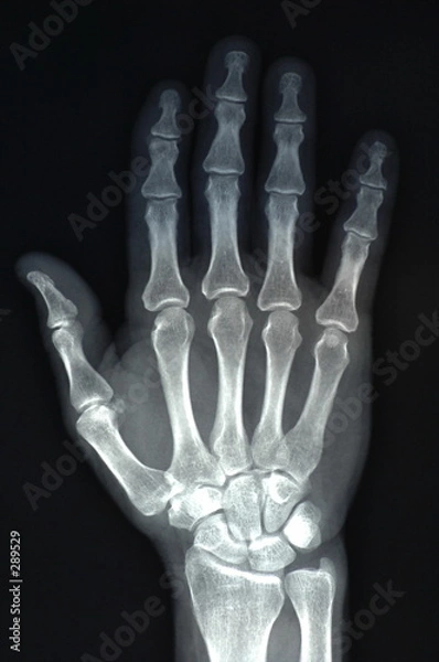 Obraz RTG dłoni