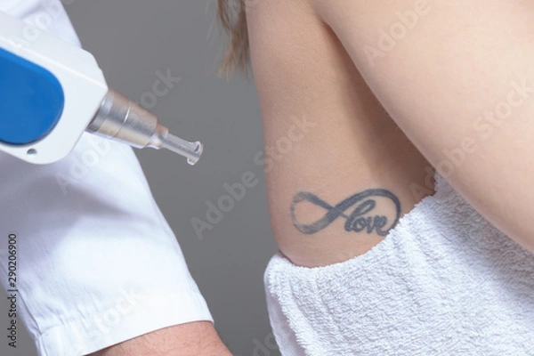 Obraz  laser tattoo removal  in clinic closeup