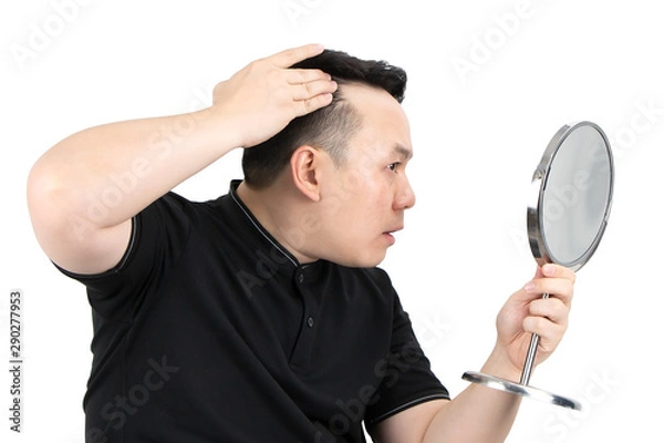 Fototapeta Portrait of serious young Asian bald man with alopecia, checking hairline while looking at the mirror isolated on white background. Hair loss, hair transplant concept.