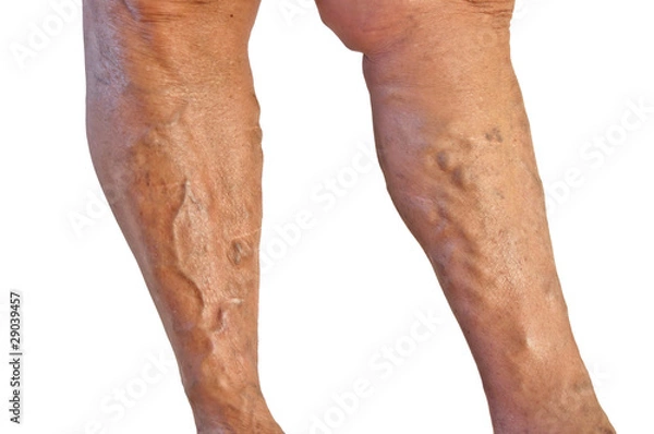 Obraz Varicose veins