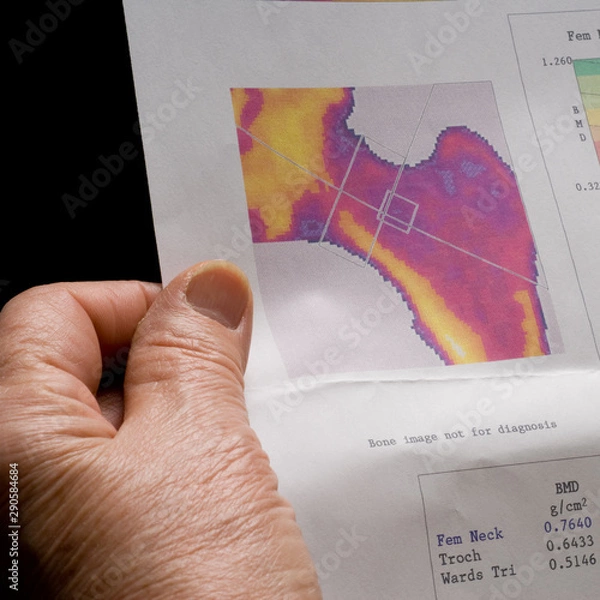 Fototapeta A hand of an old woman holding a printed paper with osteoporosis test results
