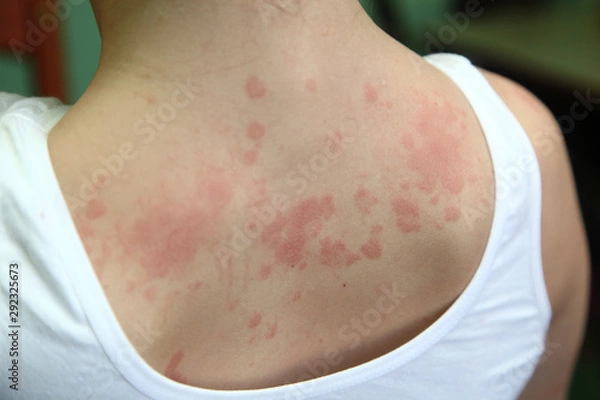 Fototapeta allergic dermatitis