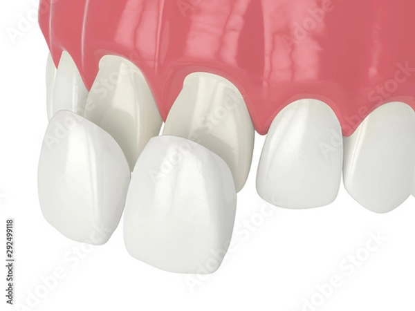 Obraz 3d render górnej szczęki z licówkami