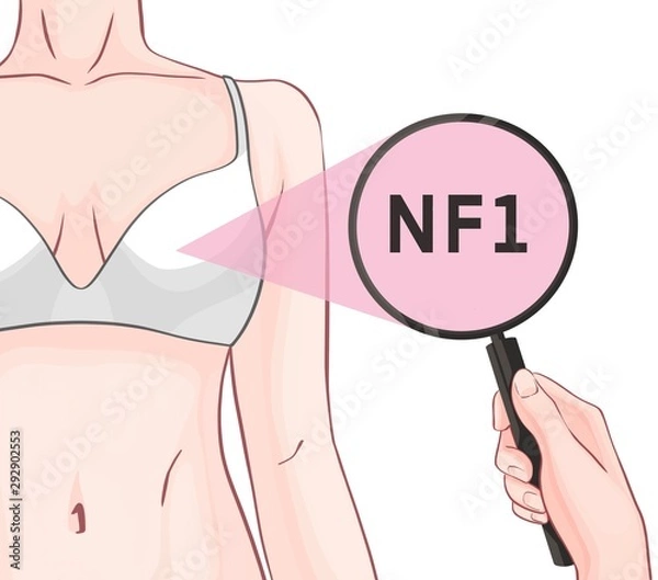 Fototapeta Variants in the NF1 gene are associated with an increased risk of developing breast cancer