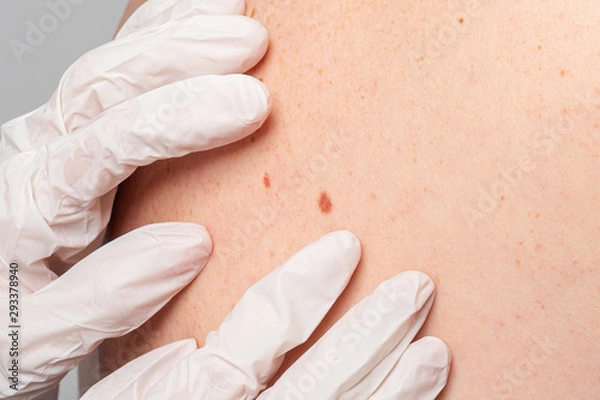 Fototapeta A doctor with gloves examines a liver spot on a person's back