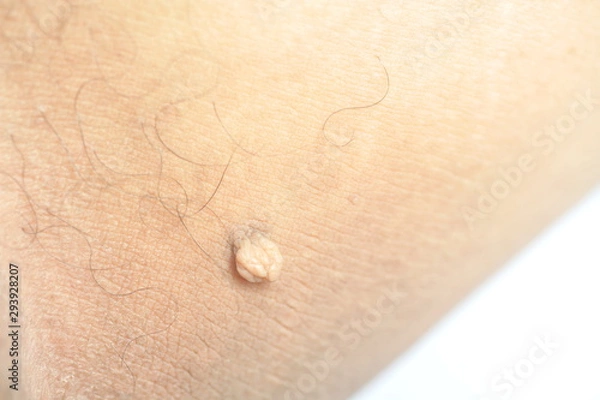 Fototapeta Pedunculated Mass skin tag or acrochondon or soft fibroma. Papilloma bump on male body macro shot on the Thigh