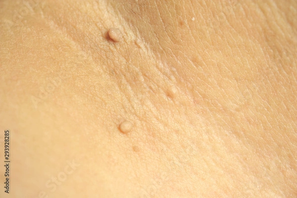 Obraz Pedunculated Mass skin tag or acrochondon or soft fibroma. Papilloma bump on male body macro shot on the Thigh