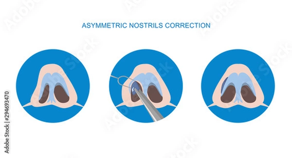 Obraz Correction of asymmetric nostrils. Rhinoplasty surgery vector. Implant. Vector illustration.