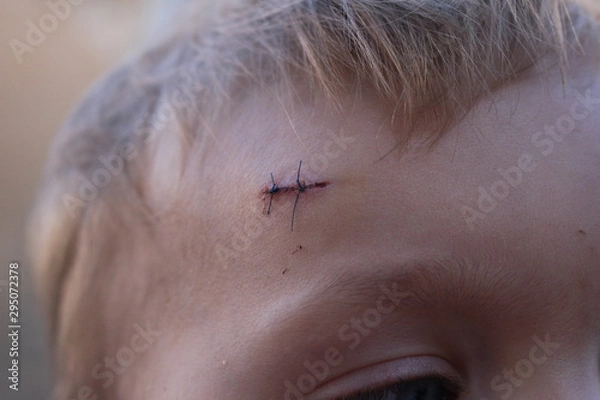 Obraz cicatrice bébé point de suture