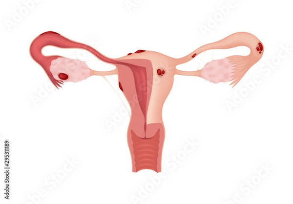 Obraz Endometriosis. Sick female reproductive system isolated on white background. Realistic drawing showing the internal organs. Frontal view in a cut.