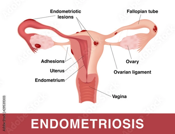 Obraz Endometriosis. Vector medical illustration with inscriptions. Realistic drawing showing sick female reproductive system.
