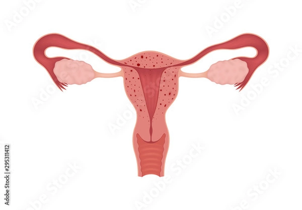 Obraz Adenomyosis. Sick female reproductive system isolated on white background. Сross section of an internal organ.