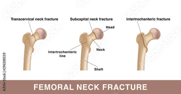 Obraz Three types of femoral neck fracture. Realistic drawing showing broken bone with inscriptions isolated on whie background.