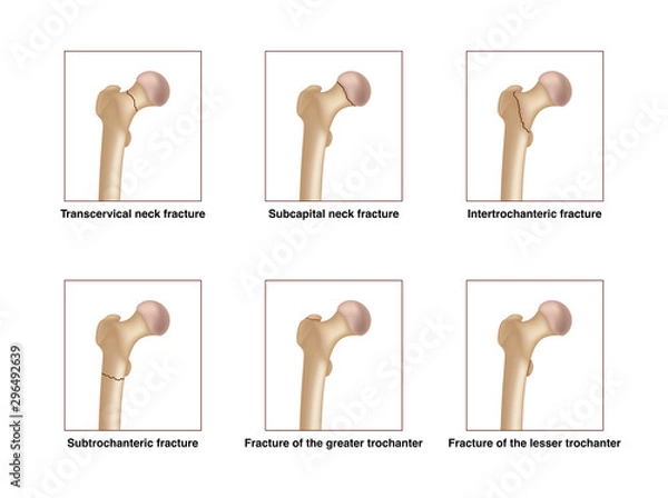 Obraz Six types of femoral neck fracture. Realistic drawing showing broken bone with inscriptions isolated on whie background.