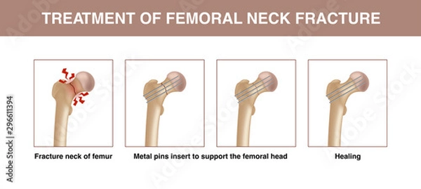 Obraz Treatment of femoral neck fracture. Vector illustration showing the strengthening of the bone fracture using parallel metal pins.