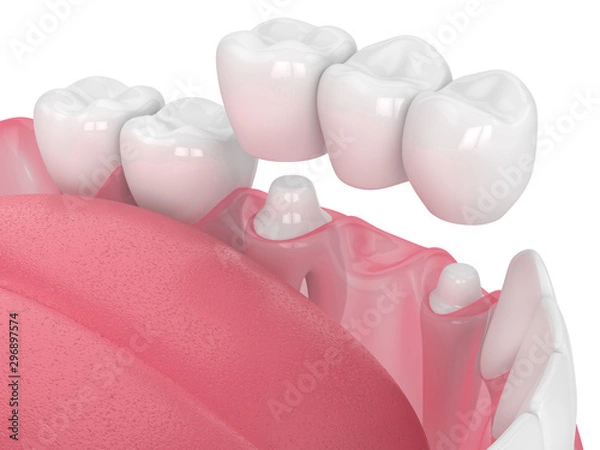 Fototapeta 3d render of jaw with dental bridge