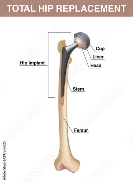 Obraz Total hip replacement. Femur with hip implant. Vector realistic medical illustration with explanations isolated on white background