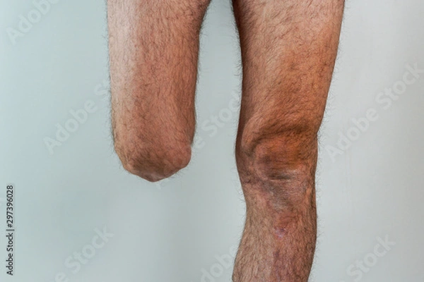 Obraz rugged man with an amputated leg isolated on White background