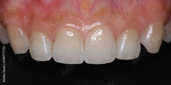 Obraz 前歯　審美