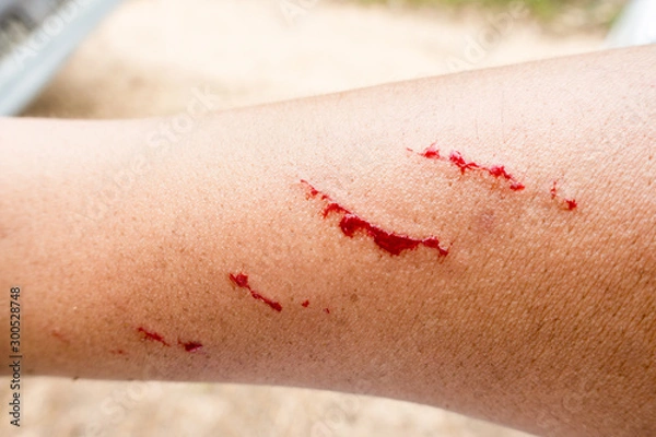 Obraz Selective focus of fresh wound with blood, A man showing a lesion under his arm, Accident wound marks on the left hand side, Injuries from falling on street.