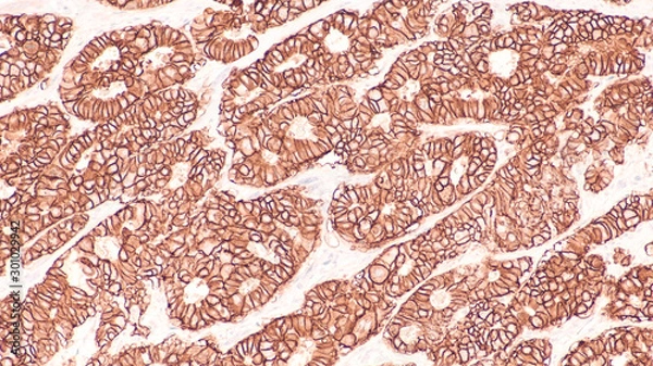 Fototapeta Photomicrograph of immunohistochemistry for HER2,  showing positive cell membrane staining in this infiltrating ductal carcinoma.   Candidate for Herceptin.