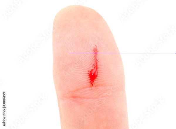 Obraz Bleeding thumb finger isolated on  white